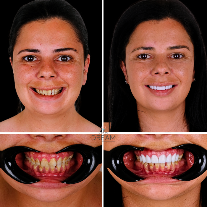 Before and after dental smile case 11