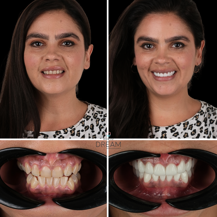 Before and after dental smile case 12