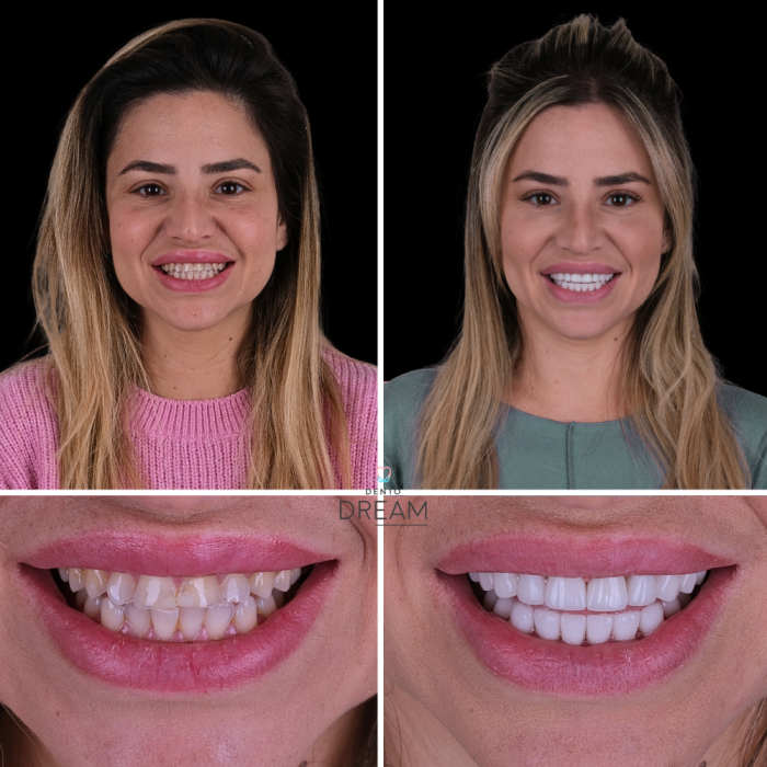 Before and after dental smile case 13