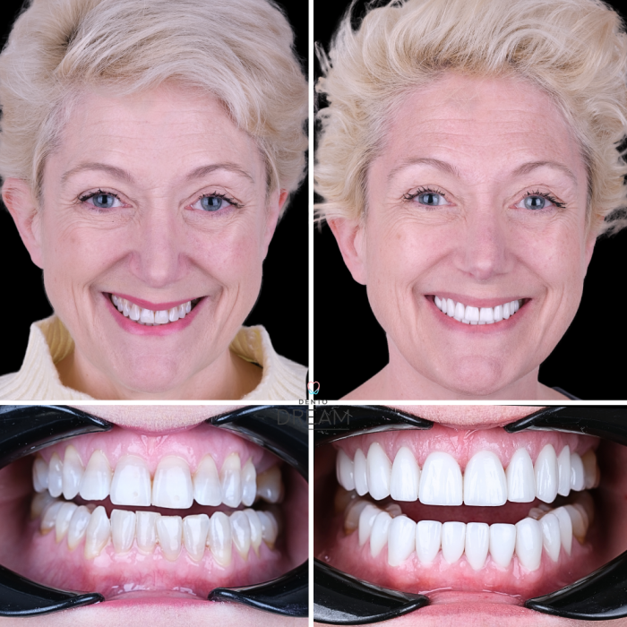 Before and after dental smile case 2
