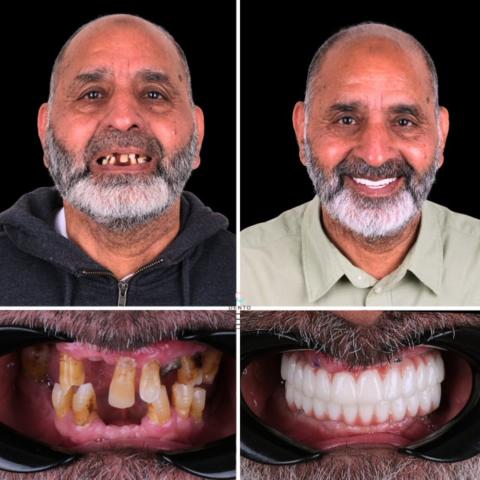 Before and after dental smile case 4