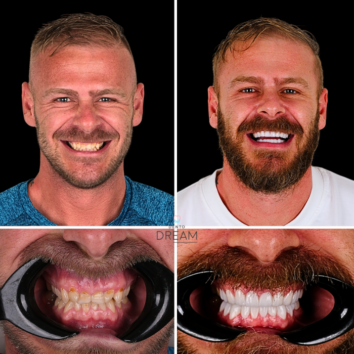 Before and after dental smile case 5