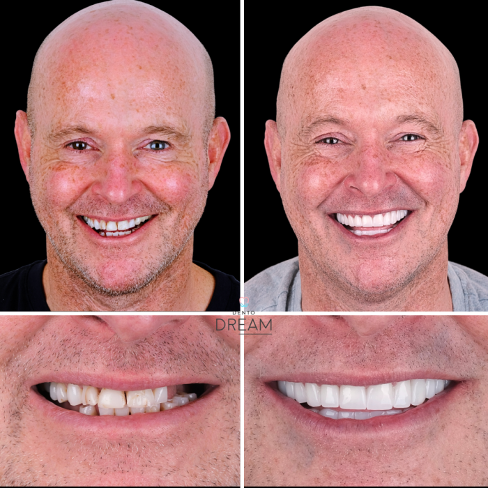 Before and after dental smile case 6