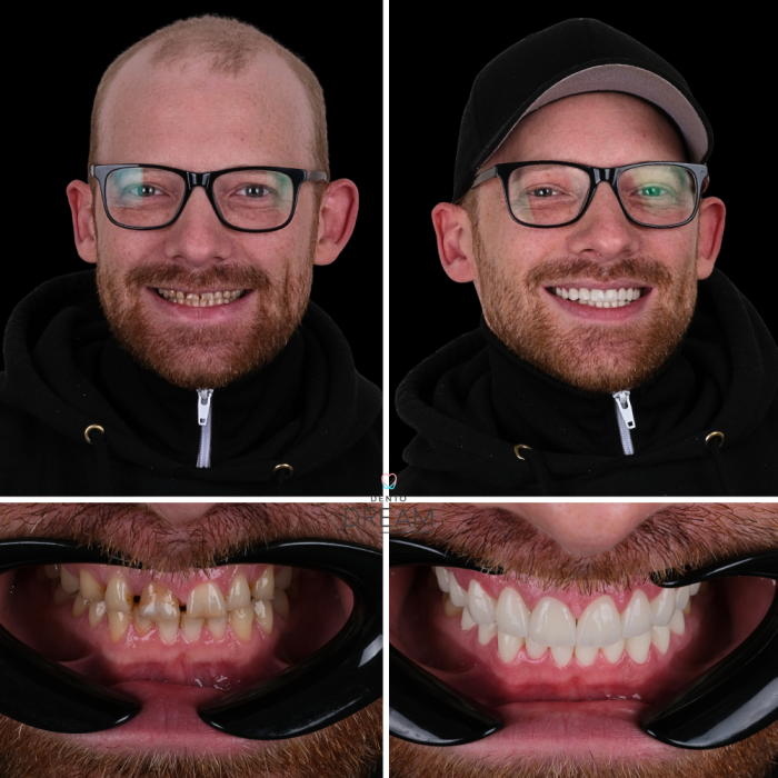 Before and after dental smile case 9