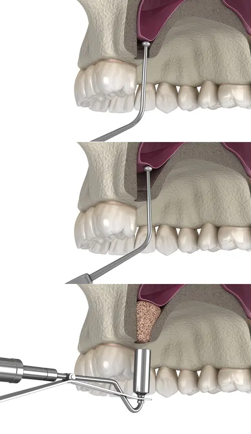 Sinus Lift Operation
